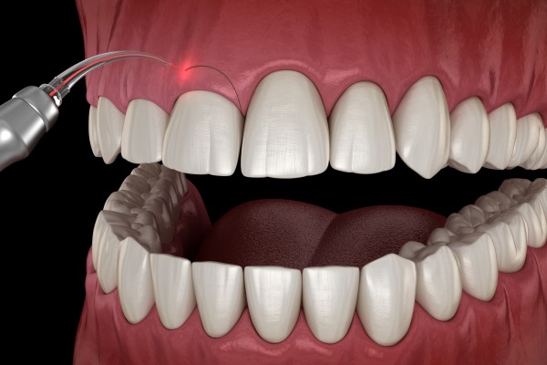 How Laser Dentistry Can Reshape Gums To Fix Your Smile